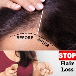 Hair Loss Treatments