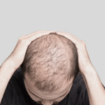 Male baldness