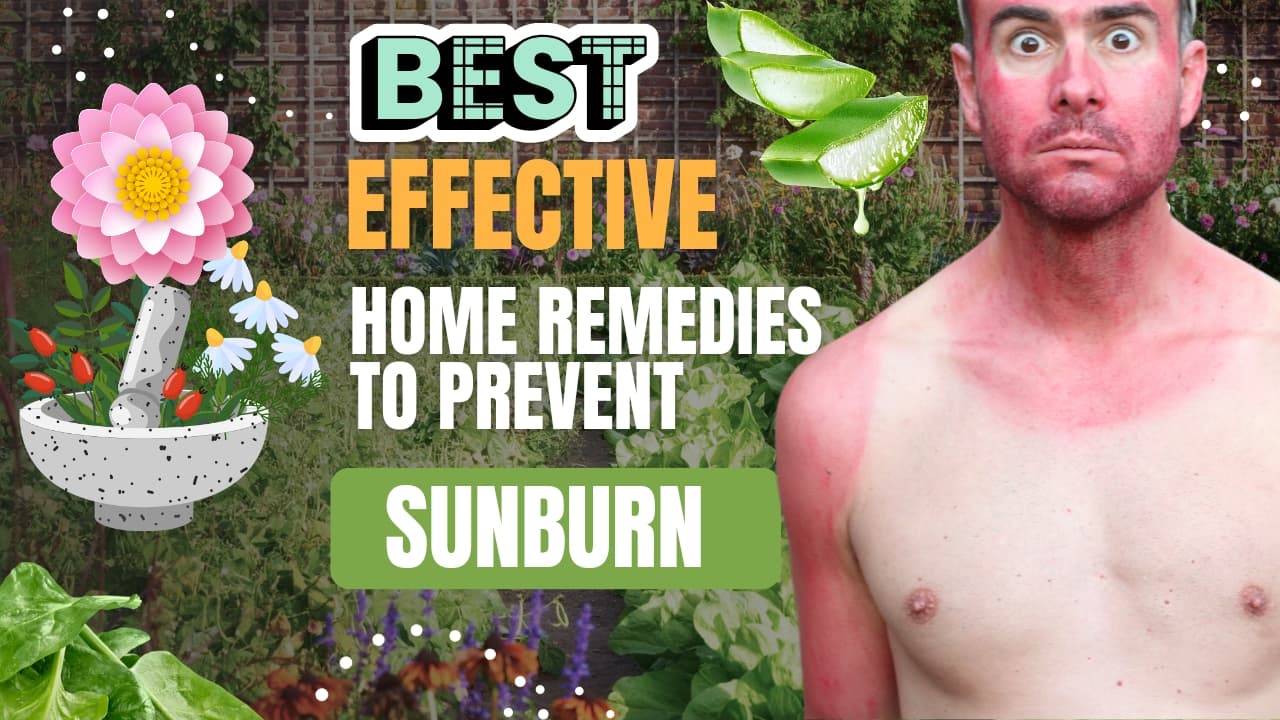 home remedies for sunburn